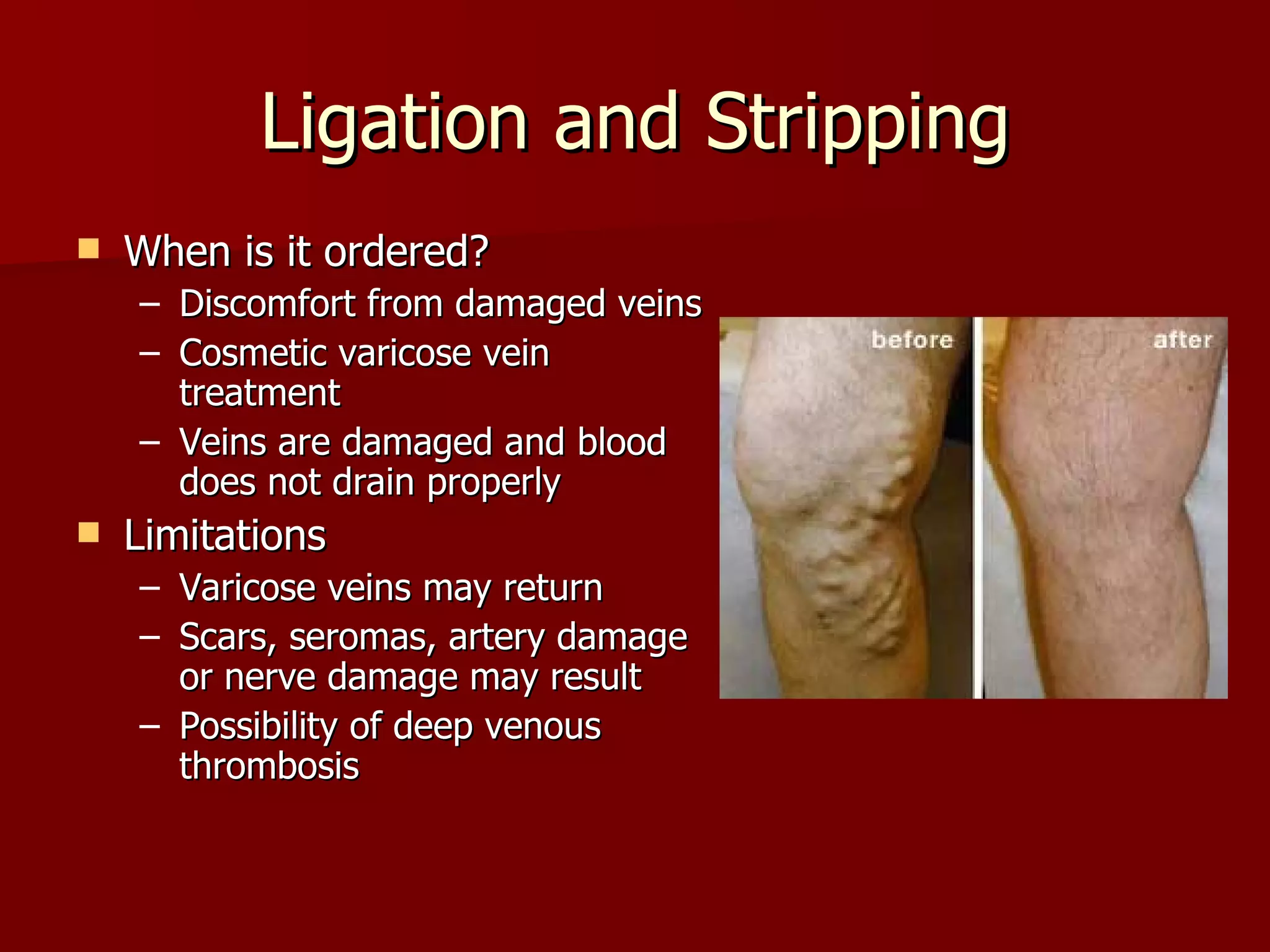 Ligation and Stripping When is it ordered? Discomfort from damaged veins Cosmetic varicose vein treatment Veins are damaged and blood does not drain properly Limitations Varicose veins may return Scars, seromas, artery damage or nerve damage may result Possibility of deep venous thrombosis 