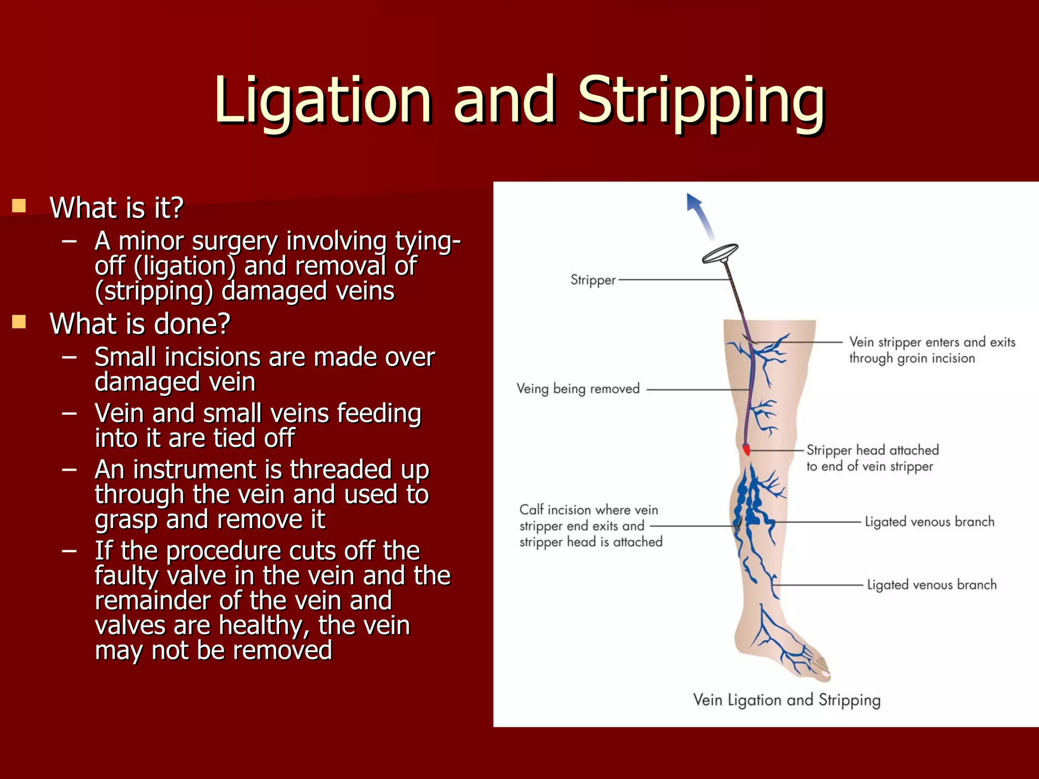 Ligation and Stripping What is it? A minor surgery involving tying-off (ligation) and removal of (stripping) damaged veins What is done? Small incisions are made over damaged vein Vein and small veins feeding into it are tied off An instrument is threaded up through the vein and used to grasp and remove it If the procedure cuts off the faulty valve in the vein and the remainder of the vein and valves are healthy, the vein may not be removed 