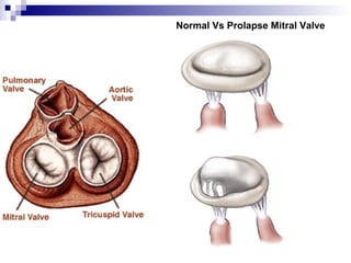 Normal Vs Prolapse Mitral Valve
 