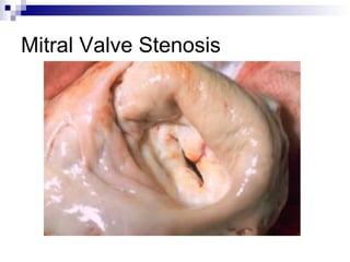 Mitral Valve Stenosis
 