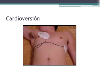 Cardioversion 100j Cardioversión | PPTX