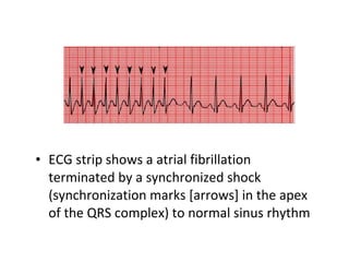 Cardioversion | PPT