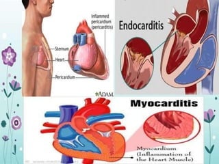 carditis.pptx carditis ppt all types and symptoms | PPTX