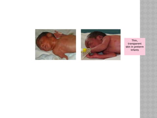 Thin,
transparent
skin in preterm
infants
 