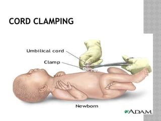 CORD CLAMPING
 