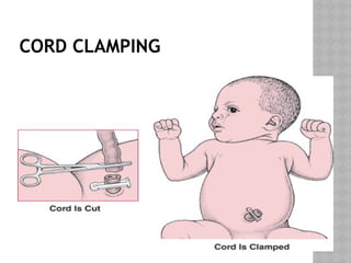 CORD CLAMPING
 