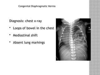 Congenital Diaphragmatic Hernia
Diagnosis: chest x-ray
• Loops of bowel in the chest
• Mediastinal shift
• Absent lung markings
 