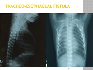 55
TRACHEO-ESOPHAGEAL FISTULA
 