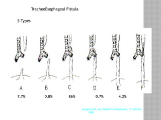 TracheoEsophageal Fistula
5 Types
Gregory GA, ed, Pediatric Anesthesia, 3rd
edition,
1996
7.7% 0.8% 86% 0.7% 4.2%
 