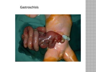 Gastroschisis
 