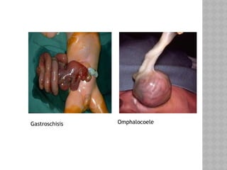 Gastroschisis Omphalocoele
 