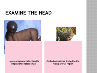 EXAMINE THE HEAD
•Huge encephalocoele. Head is
disproportionately small
Cephalhaematoma limited to the
right parietal region
 