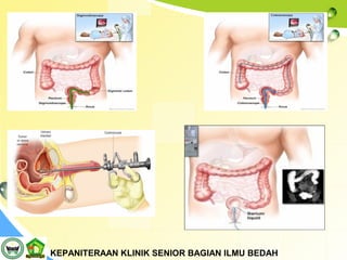 Ca recti | PPT