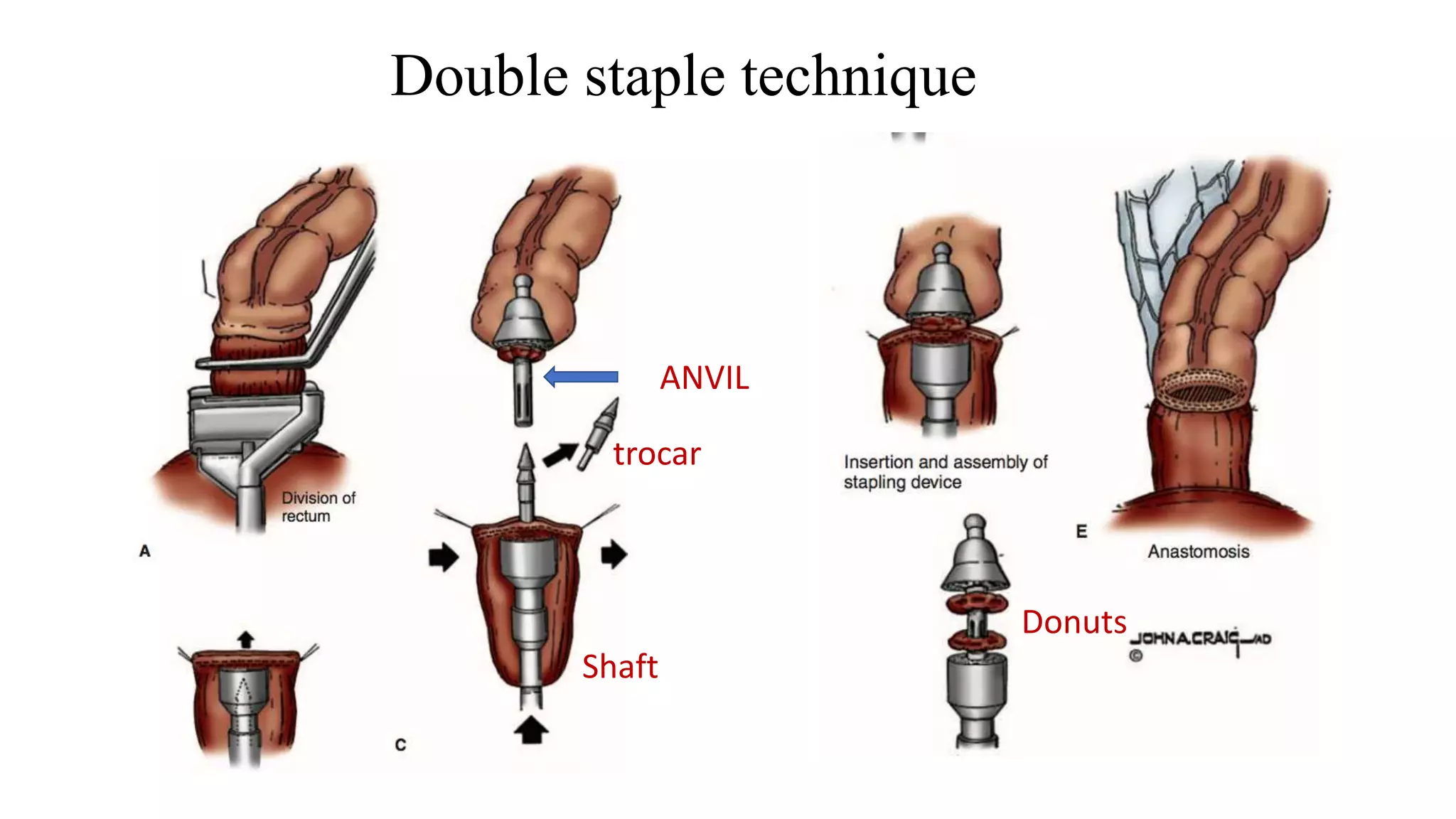 ANVIL
Double staple technique
trocar
Shaft
Donuts
 