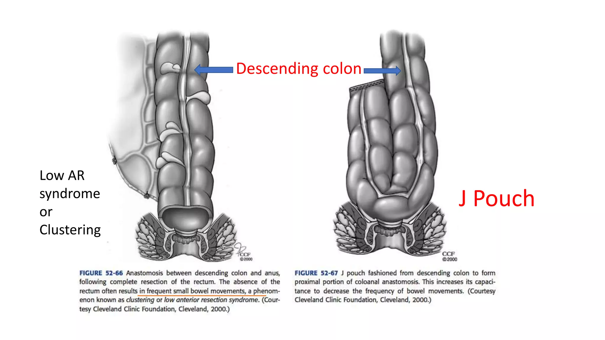J Pouch
Descending colon
Low AR
syndrome
or
Clustering
 