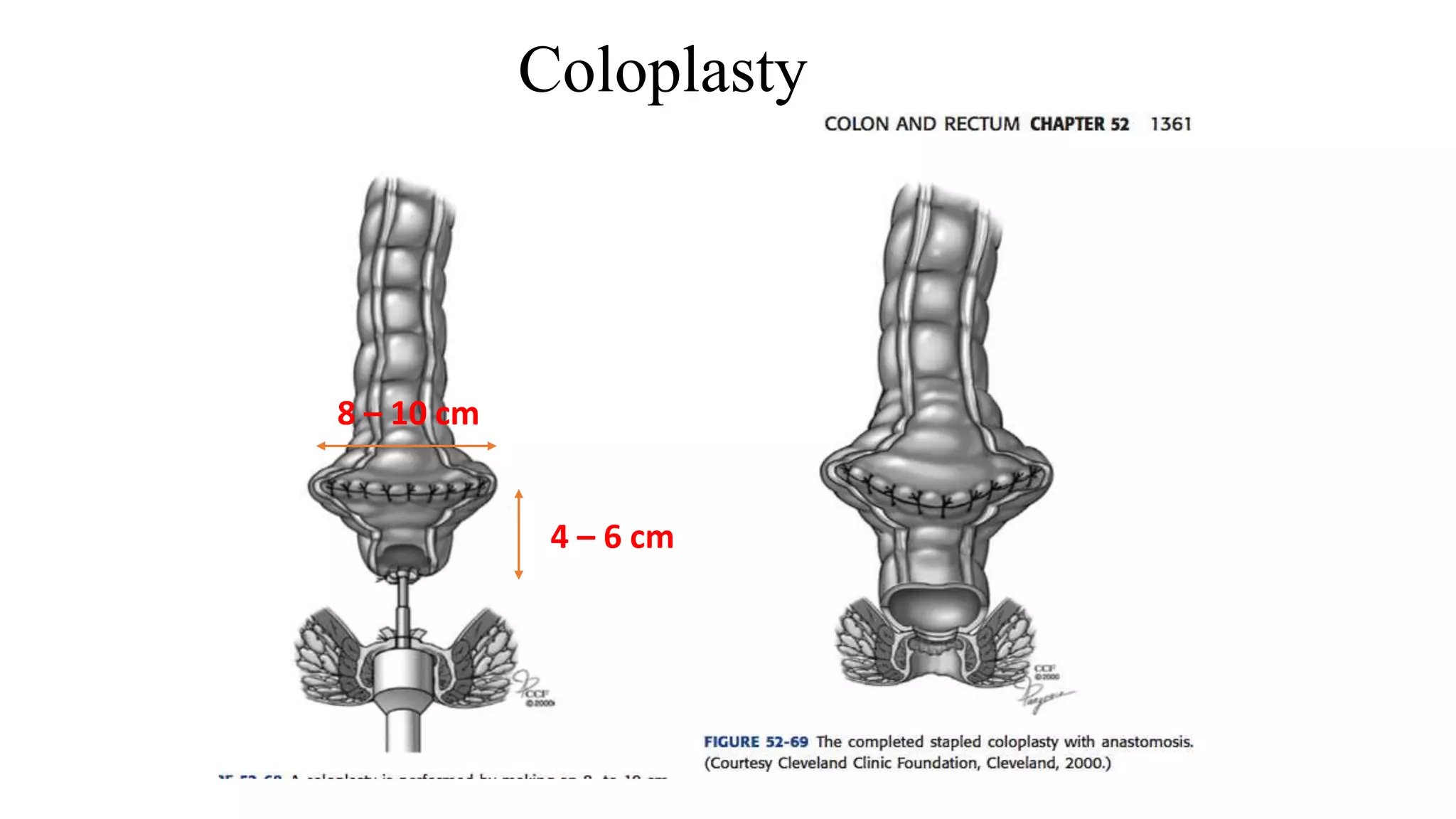 Coloplasty
8 – 10 cm
4 – 6 cm
 