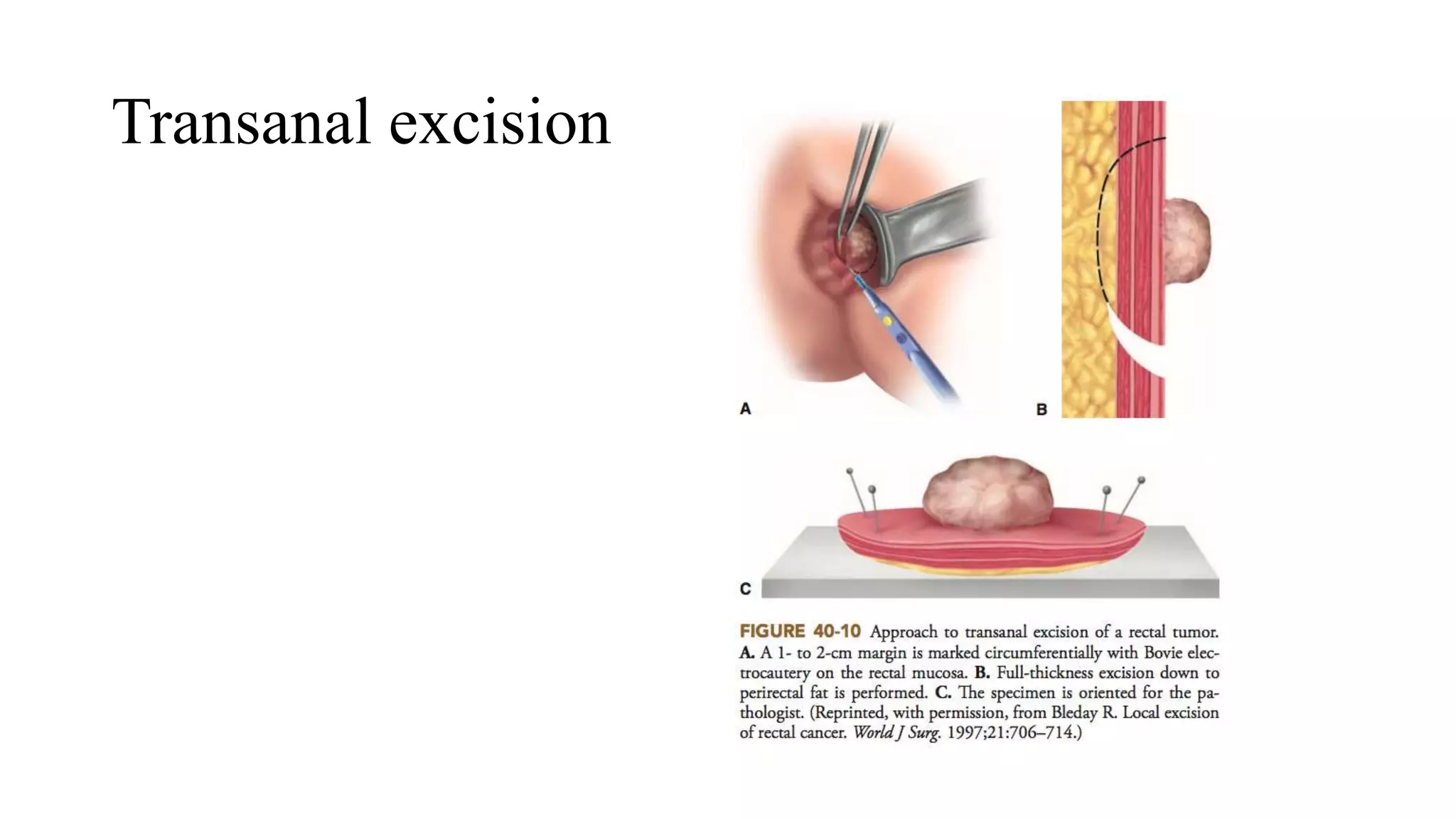 Transanal excision
 