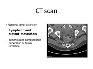 CT scan
• Regional tumor extension
• Lymphatic and
distant metastasis
• Tumor related complications -
perforation or fistula
formation
 