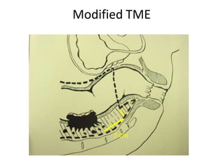 Modified TME
5 cm
5 cm
 