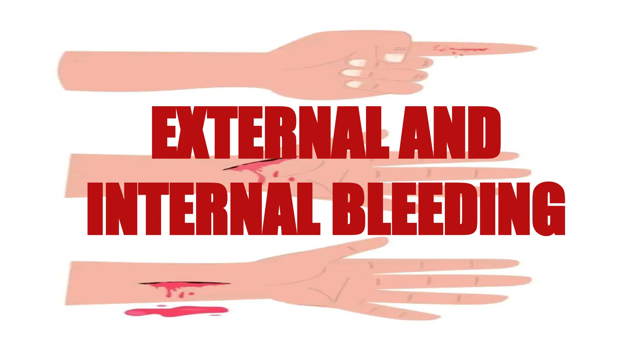 EXTERNAL AND
INTERNAL BLEEDING
 