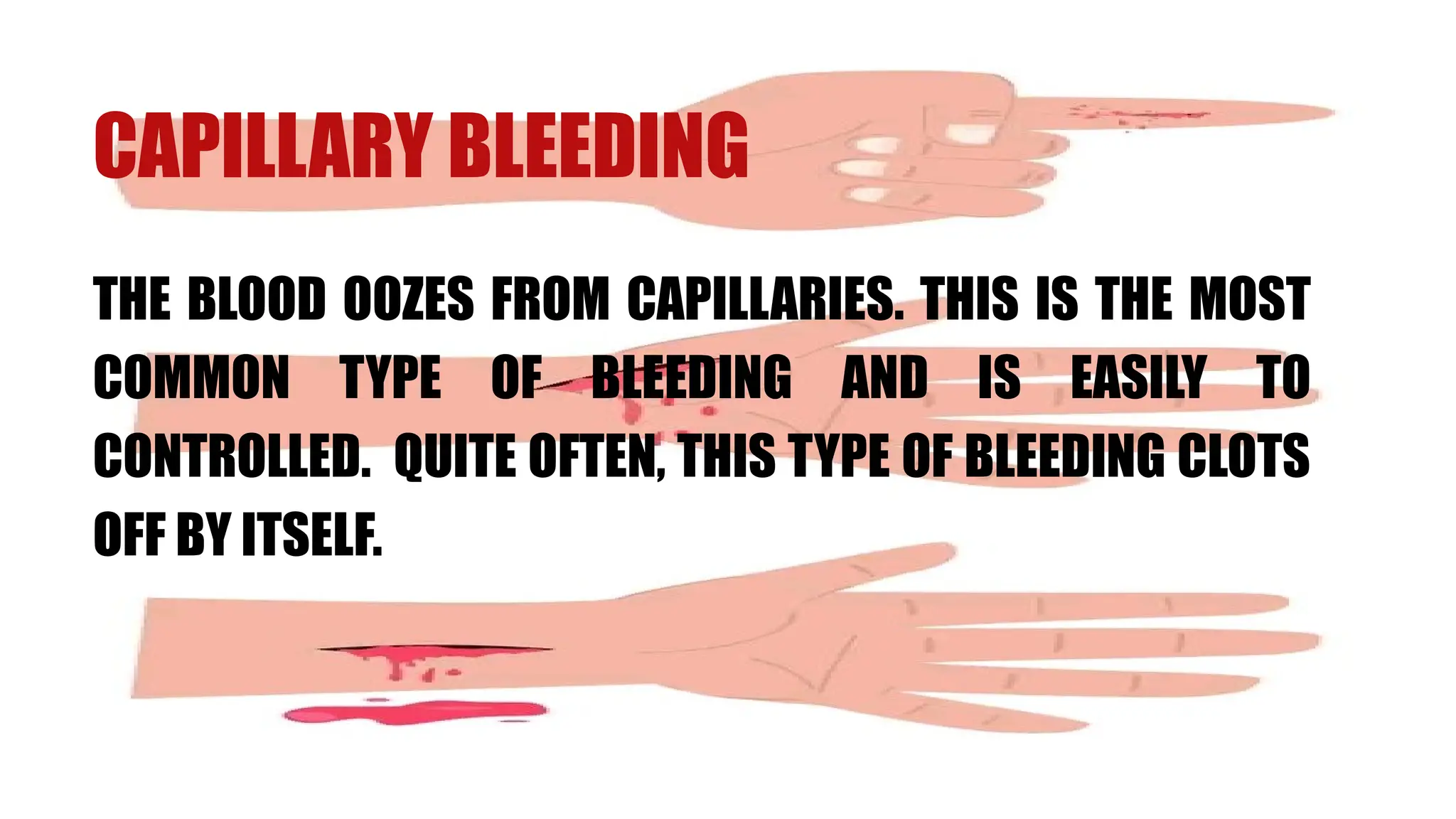 CAPILLARY BLEEDING
THE BLOOD OOZES FROM CAPILLARIES. THIS IS THE MOST
COMMON TYPE OF BLEEDING AND IS EASILY TO
CONTROLLED. QUITE OFTEN, THIS TYPE OF BLEEDING CLOTS
OFF BY ITSELF.
 