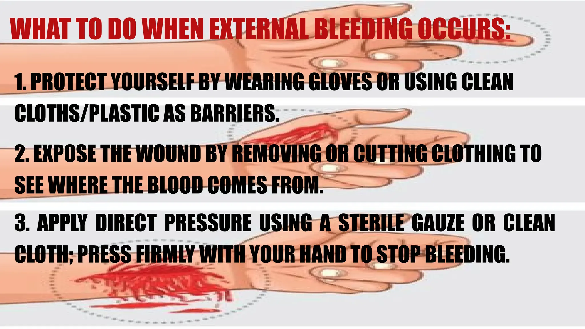 WHAT TO DO WHEN EXTERNAL BLEEDING OCCURS:
1. PROTECT YOURSELF BY WEARING GLOVES OR USING CLEAN
CLOTHS/PLASTIC AS BARRIERS.
2. EXPOSE THE WOUND BY REMOVING OR CUTTING CLOTHING TO
SEE WHERE THE BLOOD COMES FROM.
3. APPLY DIRECT PRESSURE USING A STERILE GAUZE OR CLEAN
CLOTH; PRESS FIRMLY WITH YOUR HAND TO STOP BLEEDING.
 