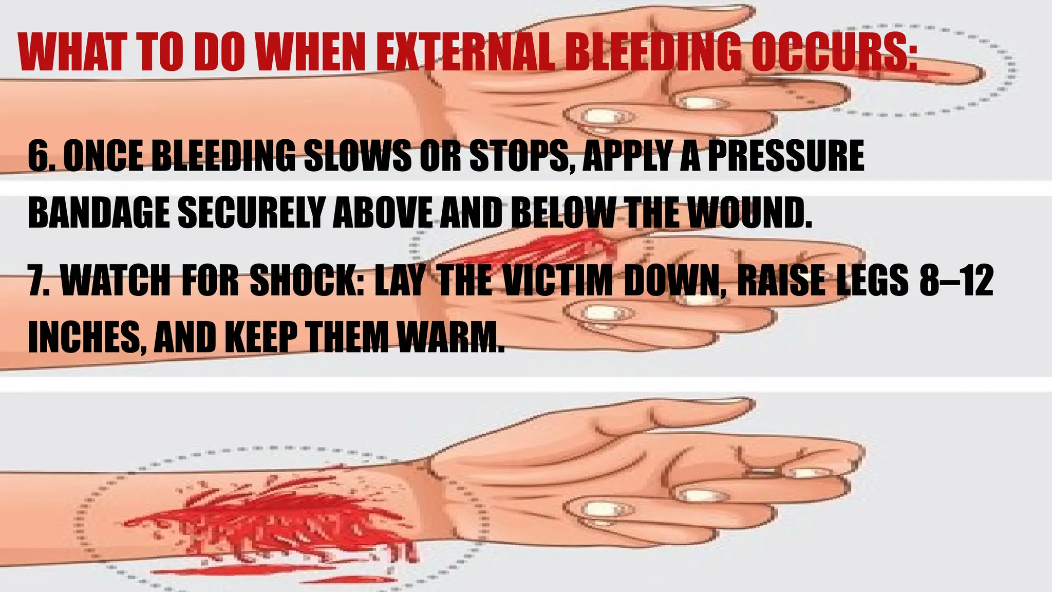 6. ONCE BLEEDING SLOWS OR STOPS, APPLY A PRESSURE
BANDAGE SECURELY ABOVE AND BELOW THE WOUND.
7. WATCH FOR SHOCK: LAY THE VICTIM DOWN, RAISE LEGS 8–12
INCHES, AND KEEP THEM WARM.
WHAT TO DO WHEN EXTERNAL BLEEDING OCCURS:
 