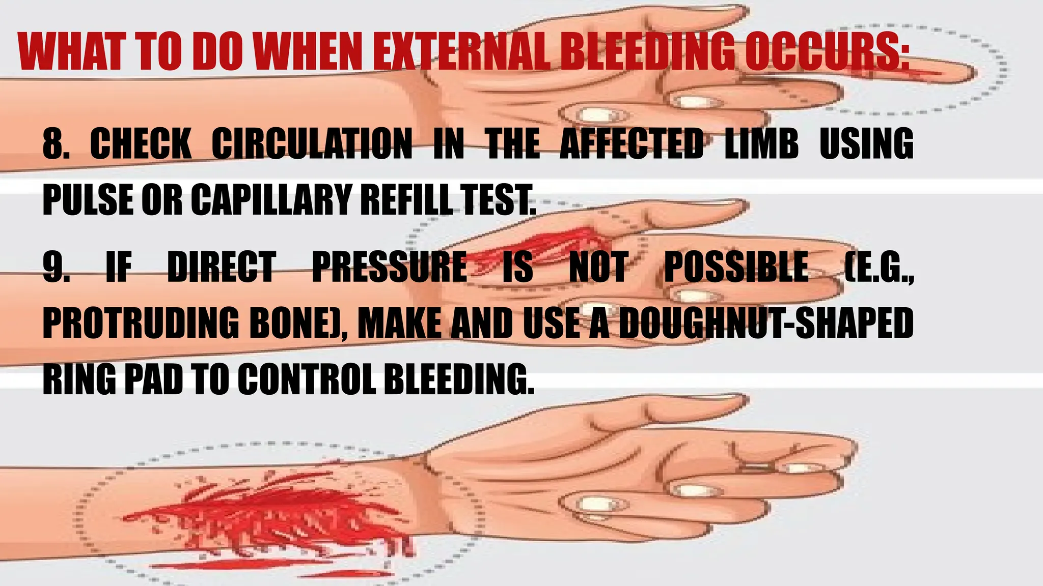 8. CHECK CIRCULATION IN THE AFFECTED LIMB USING
PULSE OR CAPILLARY REFILL TEST.
9. IF DIRECT PRESSURE IS NOT POSSIBLE (E.G.,
PROTRUDING BONE), MAKE AND USE A DOUGHNUT-SHAPED
RING PAD TO CONTROL BLEEDING.
WHAT TO DO WHEN EXTERNAL BLEEDING OCCURS:
 
