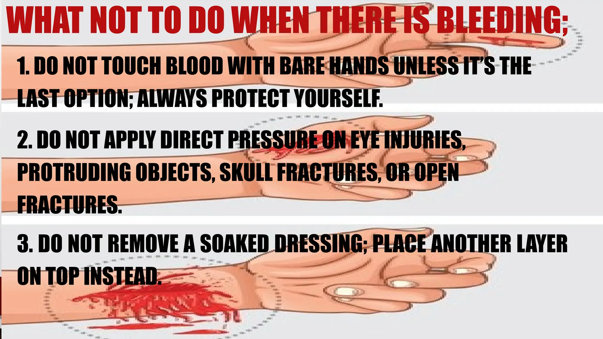 WHAT NOT TO DO WHEN THERE IS BLEEDING;
1. DO NOT TOUCH BLOOD WITH BARE HANDS UNLESS IT’S THE
LAST OPTION; ALWAYS PROTECT YOURSELF.
2. DO NOT APPLY DIRECT PRESSURE ON EYE INJURIES,
PROTRUDING OBJECTS, SKULL FRACTURES, OR OPEN
FRACTURES.
3. DO NOT REMOVE A SOAKED DRESSING; PLACE ANOTHER LAYER
ON TOP INSTEAD.
 