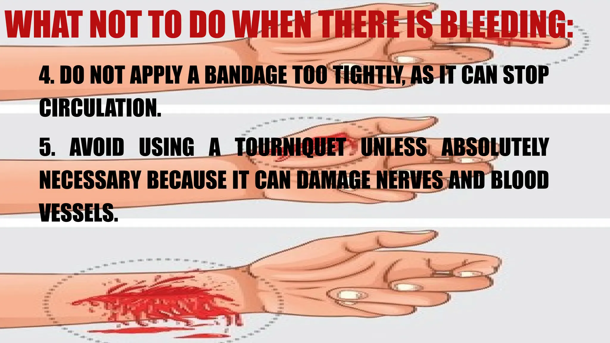 WHAT NOT TO DO WHEN THERE IS BLEEDING:
4. DO NOT APPLY A BANDAGE TOO TIGHTLY, AS IT CAN STOP
CIRCULATION.
5. AVOID USING A TOURNIQUET UNLESS ABSOLUTELY
NECESSARY BECAUSE IT CAN DAMAGE NERVES AND BLOOD
VESSELS.
 