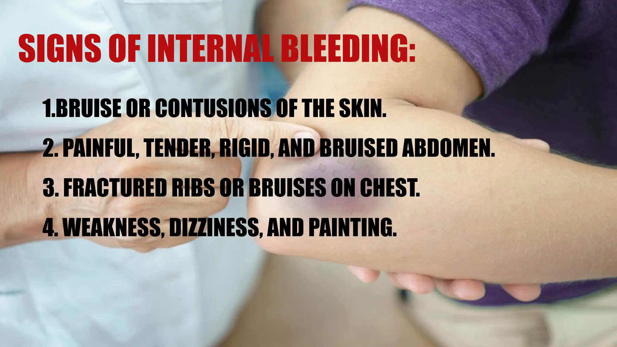SIGNS OF INTERNAL BLEEDING:
1.BRUISE OR CONTUSIONS OF THE SKIN.
2. PAINFUL, TENDER, RIGID, AND BRUISED ABDOMEN.
3. FRACTURED RIBS OR BRUISES ON CHEST.
4. WEAKNESS, DIZZINESS, AND PAINTING.
 