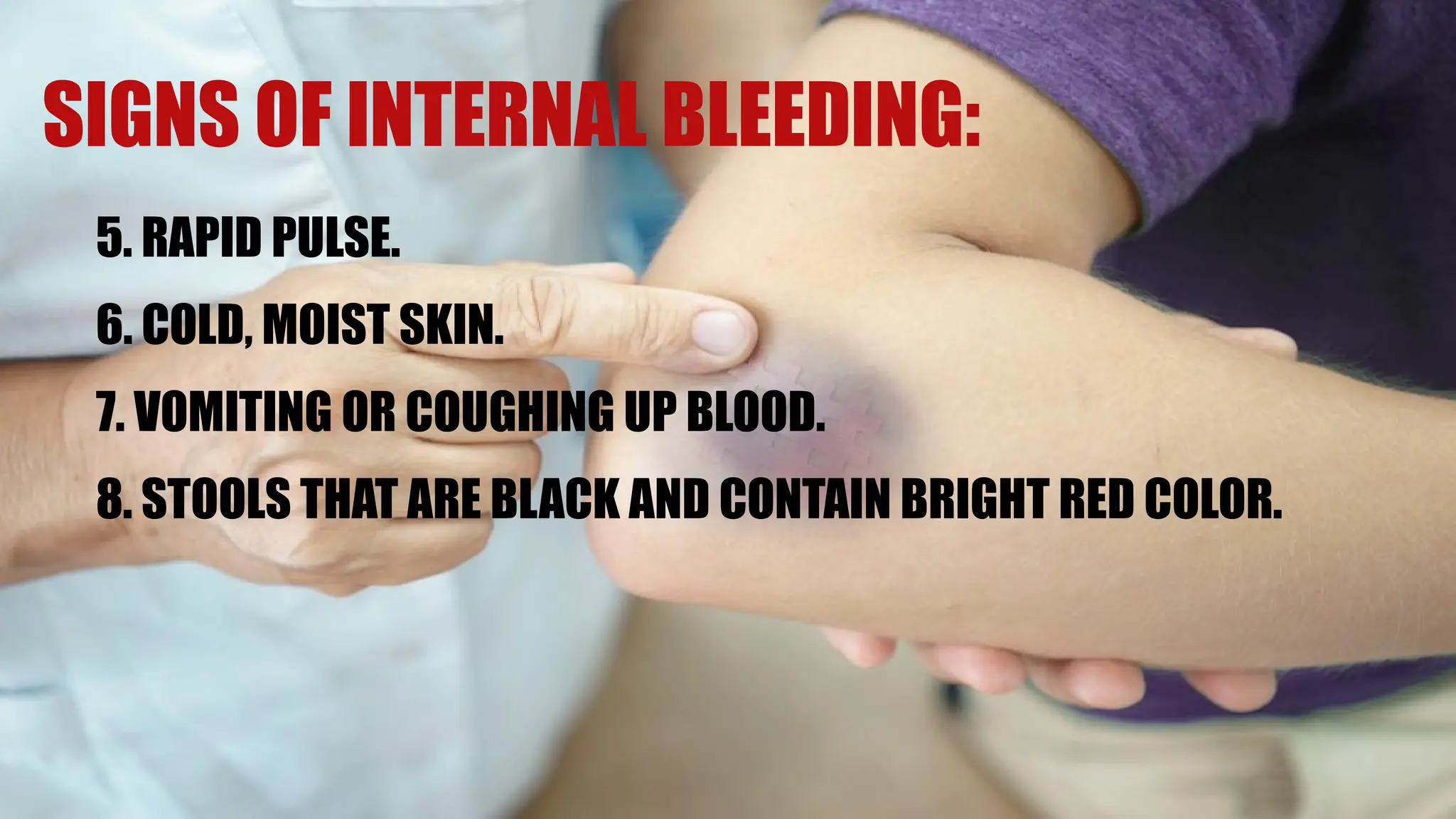 5. RAPID PULSE.
6. COLD, MOIST SKIN.
7. VOMITING OR COUGHING UP BLOOD.
8. STOOLS THAT ARE BLACK AND CONTAIN BRIGHT RED COLOR.
SIGNS OF INTERNAL BLEEDING:
 