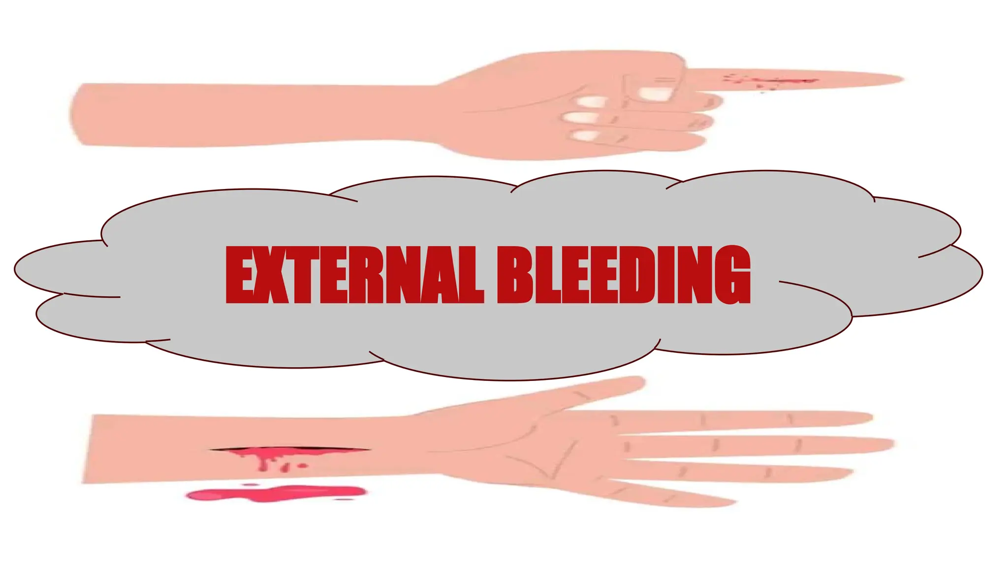 EXTERNAL BLEEDING
 