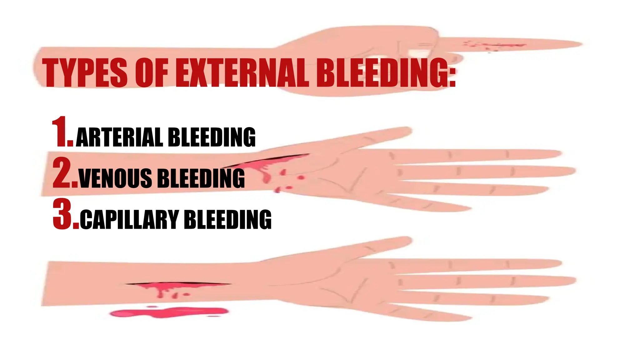 TYPES OF EXTERNAL BLEEDING:
1.ARTERIAL BLEEDING
2.VENOUS BLEEDING
3.CAPILLARY BLEEDING
 