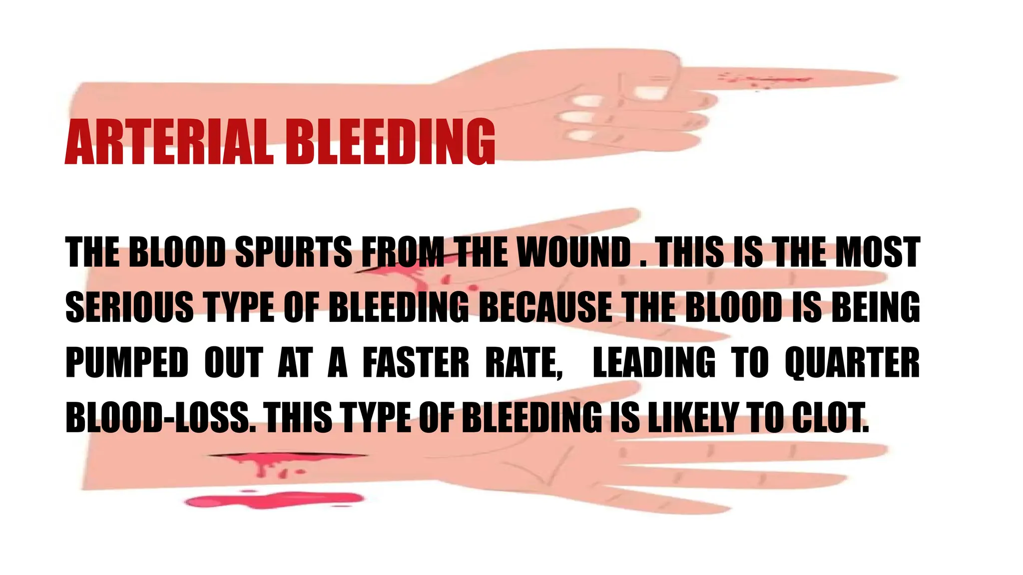 ARTERIAL BLEEDING
THE BLOOD SPURTS FROM THE WOUND . THIS IS THE MOST
SERIOUS TYPE OF BLEEDING BECAUSE THE BLOOD IS BEING
PUMPED OUT AT A FASTER RATE, LEADING TO QUARTER
BLOOD-LOSS. THIS TYPE OF BLEEDING IS LIKELY TO CLOT.
 