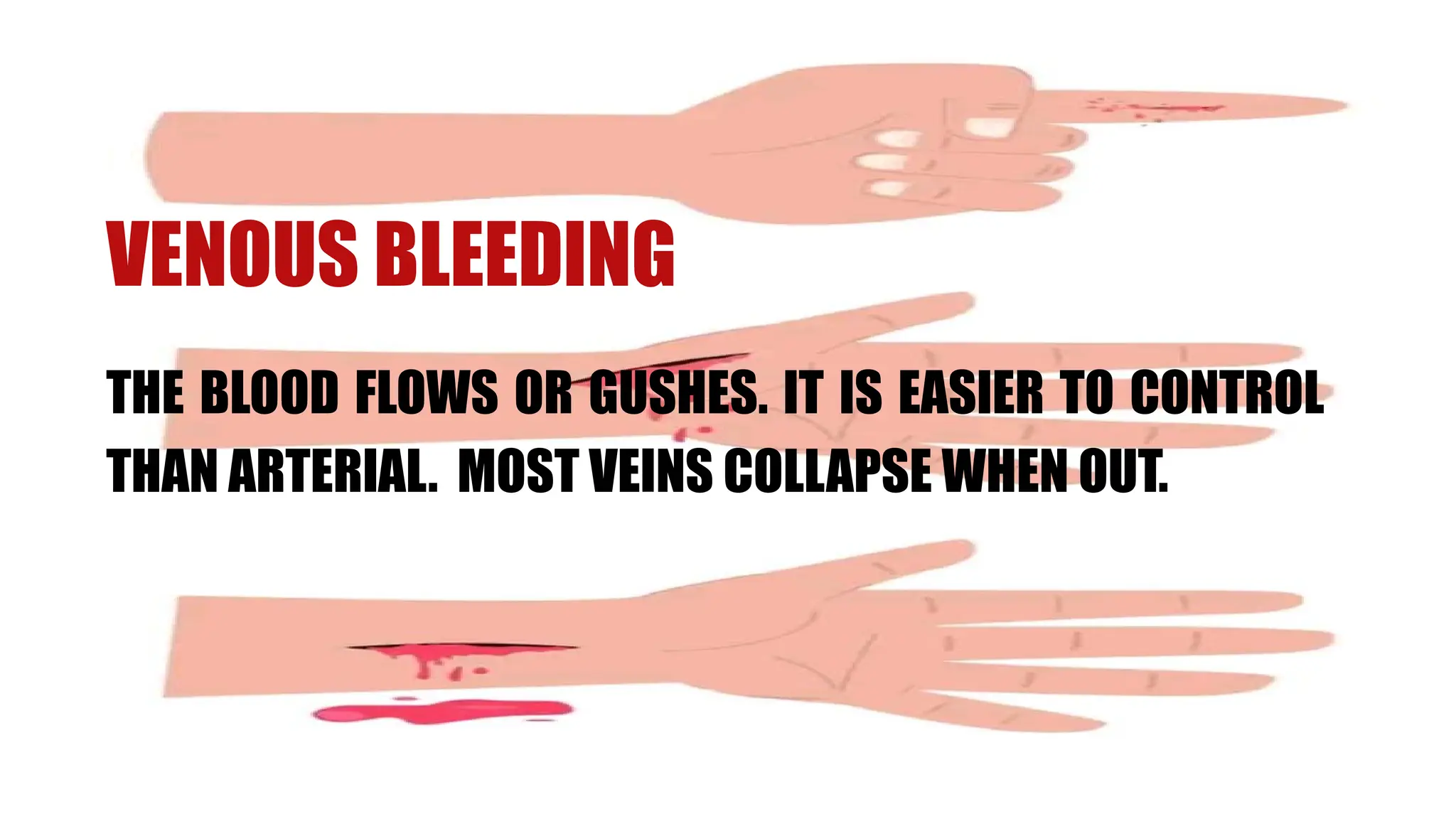 VENOUS BLEEDING
THE BLOOD FLOWS OR GUSHES. IT IS EASIER TO CONTROL
THAN ARTERIAL. MOST VEINS COLLAPSE WHEN OUT.
 