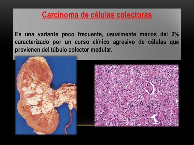 Ca renal