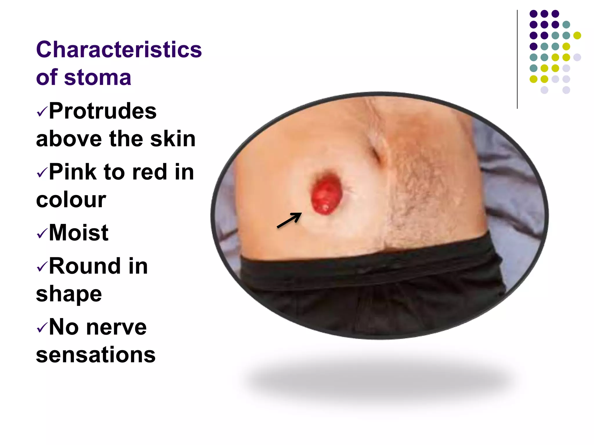 Normal Ostomy Color CARE OF PATIENTS WITH OSTOMIES ppt.pptx