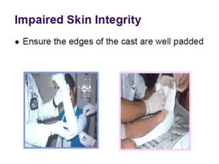 care of patient with cast.pptx
