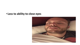 • Loss to ability to close eyes
 
