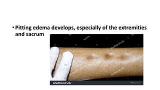 • Pitting edema develops, especially of the extremities
and sacrum
 