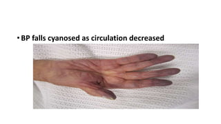 • BP falls cyanosed as circulation decreased
 