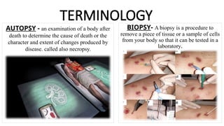 TERMINOLOGY
AUTOPSY - an examination of a body after
death to determine the cause of death or the
character and extent of changes produced by
disease. called also necropsy.
BIOPSY- A biopsy is a procedure to
remove a piece of tissue or a sample of cells
from your body so that it can be tested in a
laboratory.
 