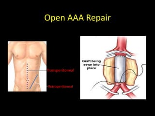 Taaa Incision Care of the Post Operative Vascular Patient.ppt