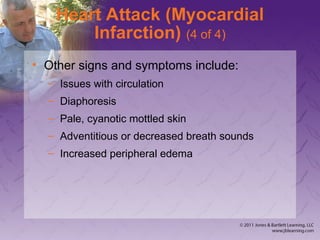 Heart Attack (Myocardial
Infarction) (4 of 4)
• Other signs and symptoms include:
– Issues with circulation
– Diaphoresis
– Pale, cyanotic mottled skin
– Adventitious or decreased breath sounds
– Increased peripheral edema
 