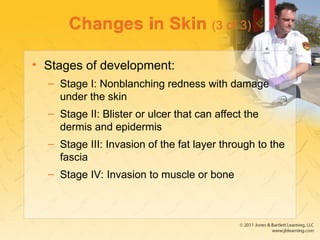 Changes in Skin (3 of 3)
• Stages of development:
– Stage I: Nonblanching redness with damage
under the skin
– Stage II: Blister or ulcer that can affect the
dermis and epidermis
– Stage III: Invasion of the fat layer through to the
fascia
– Stage IV: Invasion to muscle or bone
 