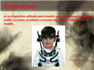 Tracción de halo:
es un dispositivo utilizado para impedir que usted mueva su cabeza y
cuello. Los halos se utilizan a menudo si su fractura craneal no es
estable.
 