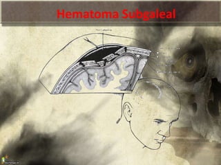 Hematoma Subgaleal
 