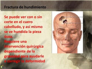 Fractura de hundimiento
Se puede ver con o sin
corte en el cuero
cabelludo, y así mismo
se ve hundida la pieza
ósea.
Requiere una
intervención quirúrgica
dependiente de la
gravedad para ayudarle
a corregir la deformidad
 