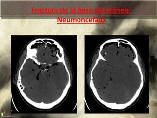 Fractura de la base del cráneo:
Neumoncefalo
 